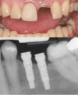 Dental implants before and x-ray 