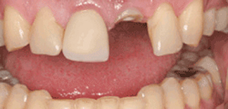 Dental bridges needed in a mouth