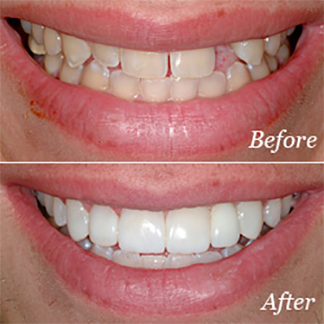 Dental bridges before and after
