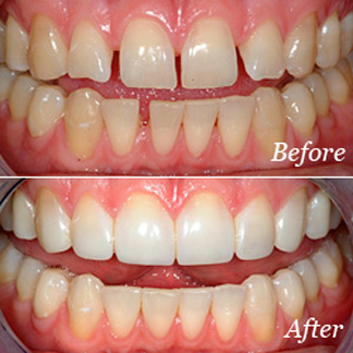 Cosmetic veneers before and after